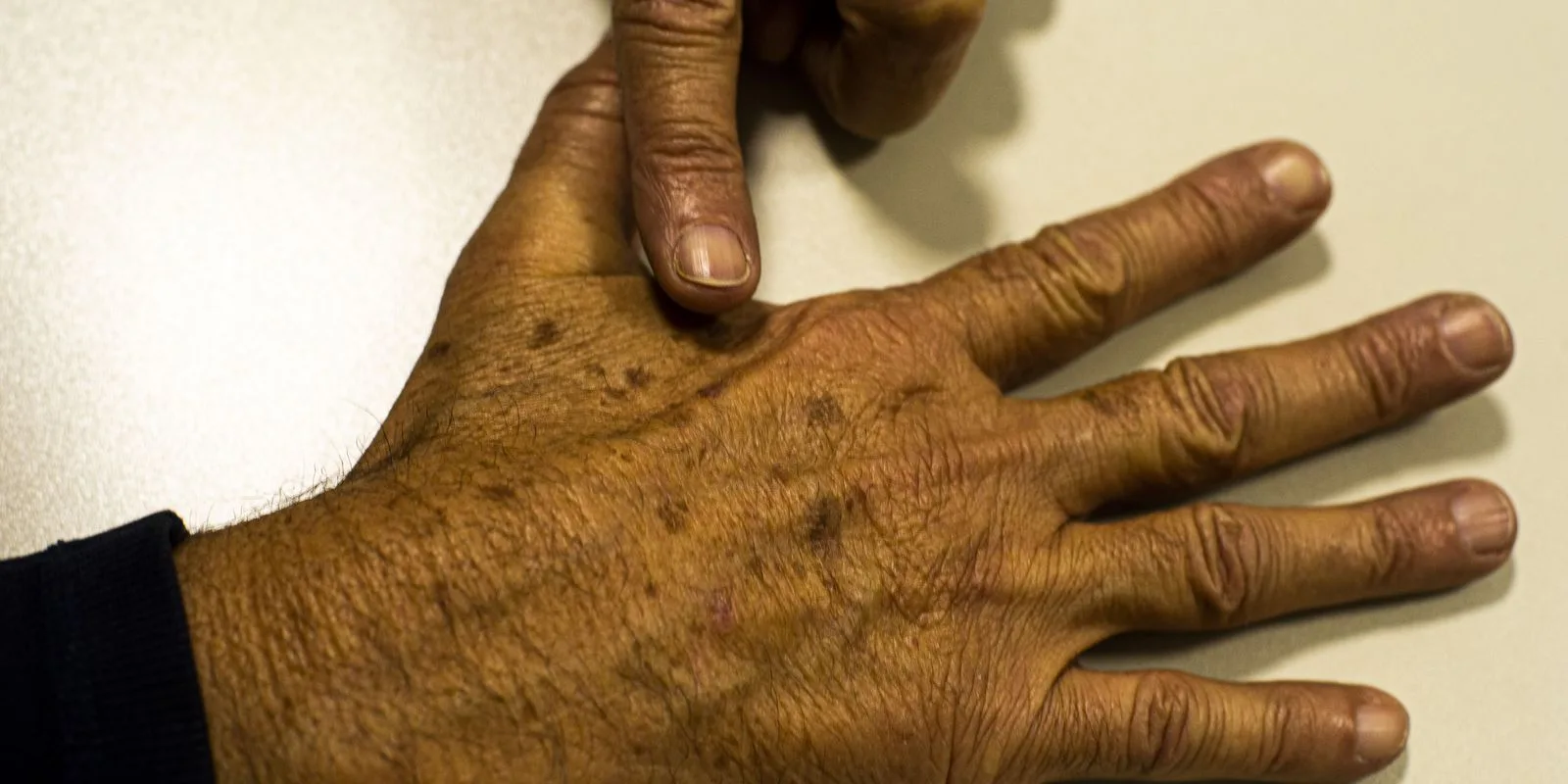 Aprovação para uso no SUS de tecnologia para o tratamento do câncer de pele