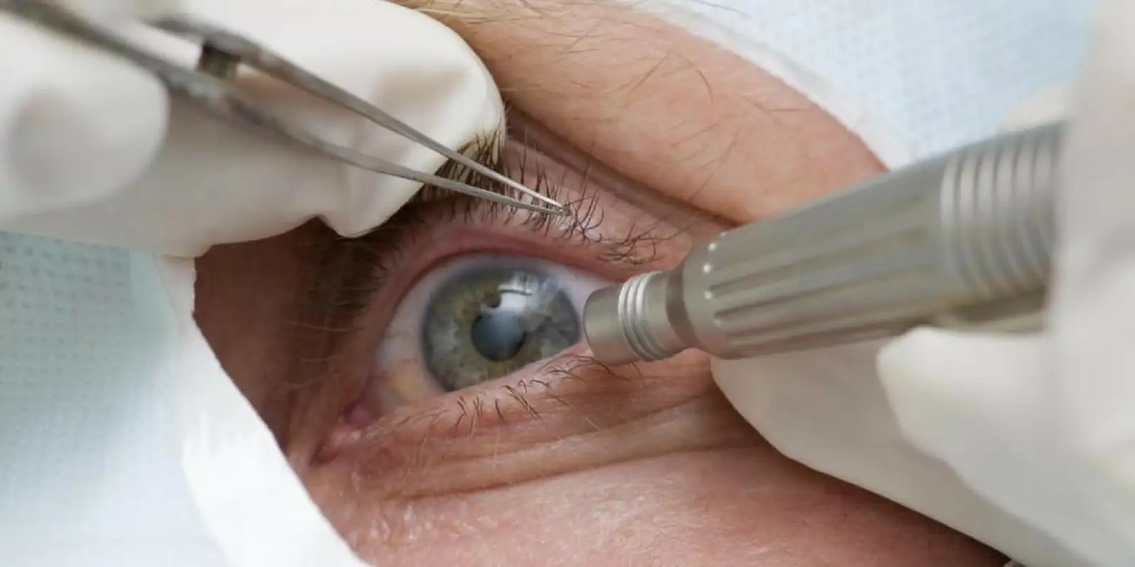 Médicos advertem sobre os perigos da cirurgia para mudar a cor dos olhos